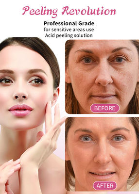 30 ml Hautpeeling-Serum / professionelles Flüssigkeitsset für Gesichtshaut-Exfoliationslösung