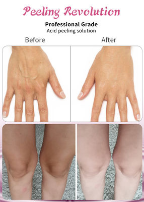 Professionelle Säure-Peeling-Lösung Flüssigkeit für die Gesichtspeeling
