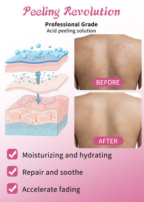 Professionelle Haut Exfoliation Serum Set Hautpflege Produkte Reinigung Wiederherstellung der Haut Revitalieren Exfoliating Lösung