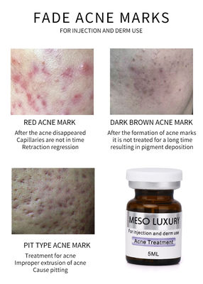 Rote Stellen Luxusjugend-Serum-Einspritzung Mesotherapy enthäuten Akne-Einspritzungs-Behandlung